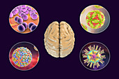 Brain infections, illustration