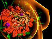 Breast cancer, illustration