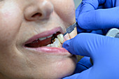 Dental implant colour matching