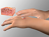 Atopic dermatitis treatment, illustration