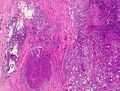 Hodgkin lymphoma, light micrograph