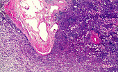 Hypertensive kidney disease, light micrograph