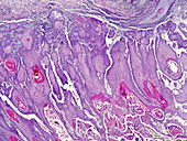 Cutaneous squamous cell carcinoma, light micrograph