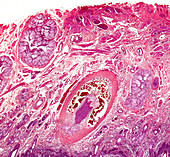 Squamous cell carcinoma, light micrograph
