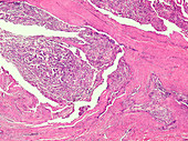 Human papillary thyroid carcinoma, light micrograph