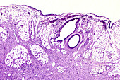Granulation tissue, light micrograph