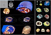 Human head, CT scans