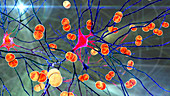 Bacterial brain infection, illustration