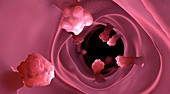 Intestinal polyps, illustration