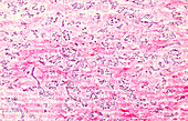 Chronic breast mastitis, light micrograph
