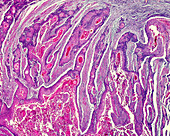 Carcinoma of the oesophagus, light micrograph