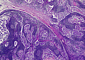 Secondary lymph node cancer, light micrograph