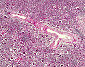 Cresentic glomerulonephritis, light micrograph