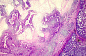 Ovarian teratoma, light micrograph