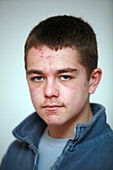 Teenage boy with acne