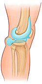 Baker's cyst, illustration