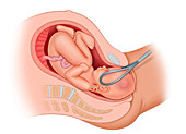 Forceps delivery, illustration