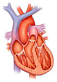 Heart with enlarged ventricle, illustration