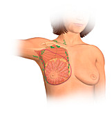 Radical mastectomy, illustration