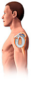 Shoulder injury, illustration
