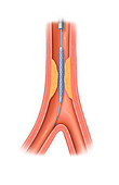 Stent to treat narrowed artery, illustration