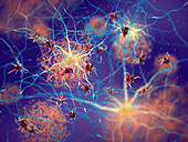 Amyloid plaques in Alzheimer's disease, illustration