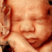 32 week foetus, 3-D ultrasound scan