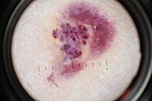 Haemangioma, dermatoscope image