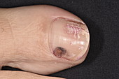 Bruised toenail