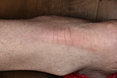 Swollen Achilles tendon