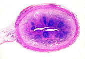 Human acute appendicitis, light micrograph