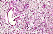 Human anthracosis in lung tissue, light micrograph