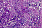 Necrotic pneumonia, light micrograph