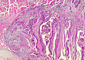 Cornification of squamous cancerous cells, light micrograph