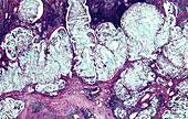 Mucinous gastric carcinoma, light micrograph