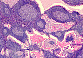 Pleomorphic adenoma, light micrograph