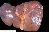 Unhealthy human liver