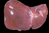 Congestive hepatopathy