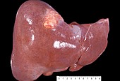Hydatid cyst of the liver