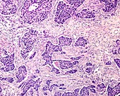 Invasive ductal carcinoma, light micrograph