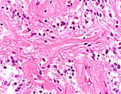 Pilocytic astrocytoma, light micrograph