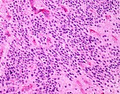 Anaplastic ependymoma, light micrograph