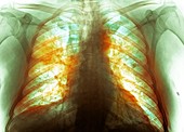 Lungs affected by Covid-19, X-ray