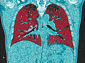 Covid-19 affected lungs
