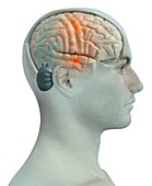 Deep brain stimulation, illustration