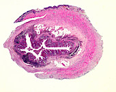 Chronic appendicitis, light micrograph