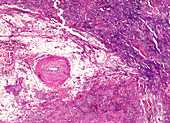 Chronic glomerulonephritis, light micrograph