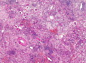 Vitreous renal arterial degeneration, light micrograph