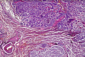 Adenosquamous carcinoma of the lung, light micrograph