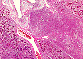 Lobar pneumonia, light micrograph